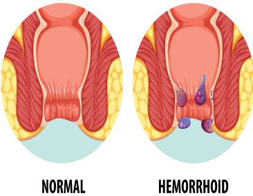 Hemoroid'in Tedavi Türleri